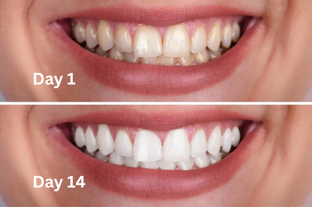Before and after comparison of teeth whitening results on Day 1 and Day 14.
