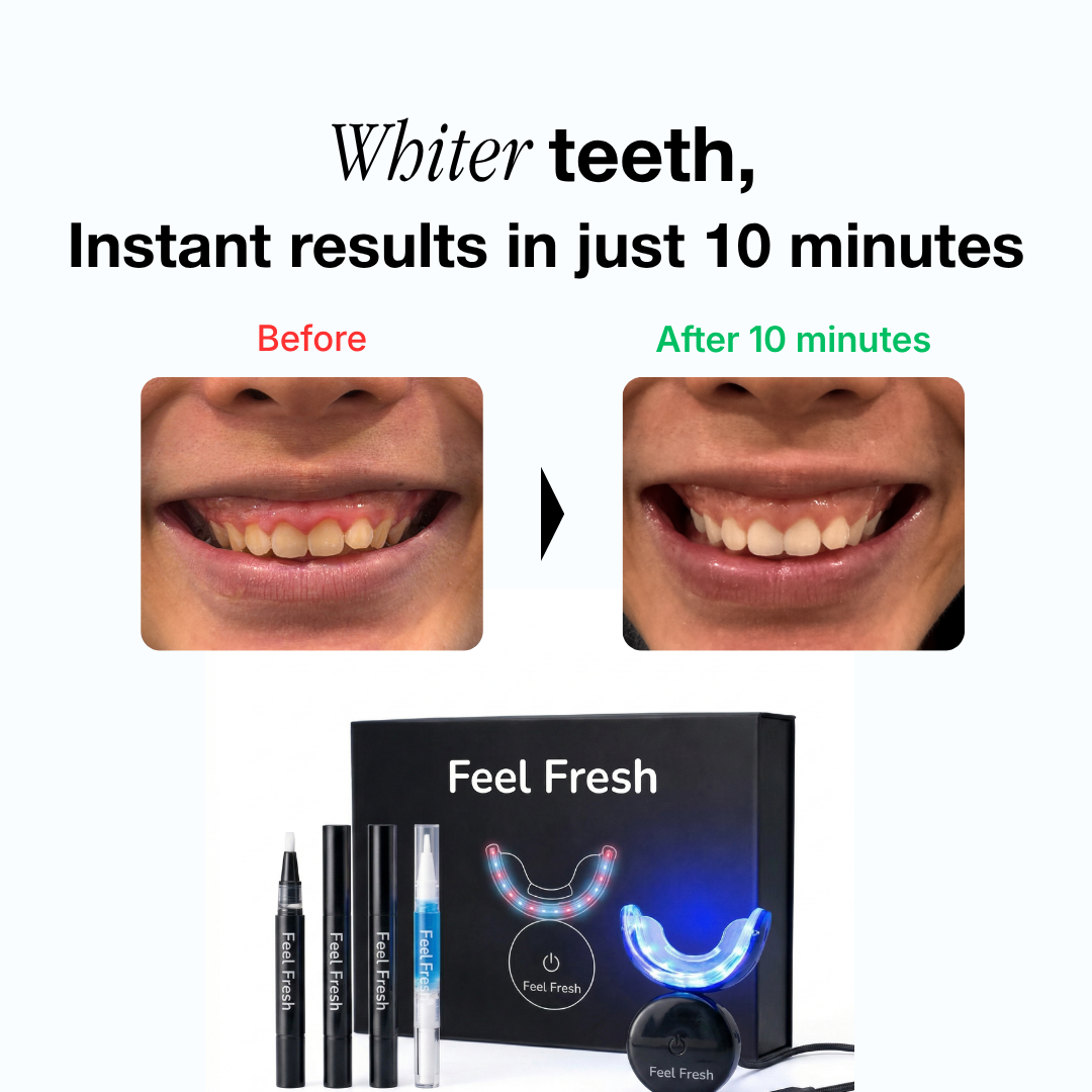 LED teeth whitening kit before and after results - whiter teeth in 10 minutes with Feel Fresh whitening kit Singapore